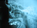 Grayscale x-ray image of a human skull. This left lateral cephalametric radiograph shows a profile of the human skull. The maxilla and some crowned teeth make up most of the image. Above that four faint nail like structures are visible.